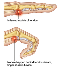artroza mucoasei tratamentului articulației genunchiului