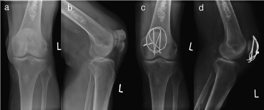 tratamentul fracturii de patelă durere în partea externă a articulației șoldului