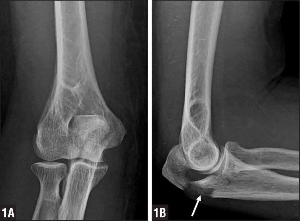 fracturi și leziuni ale articulației cotului articulațiile genunchiului adesea doare