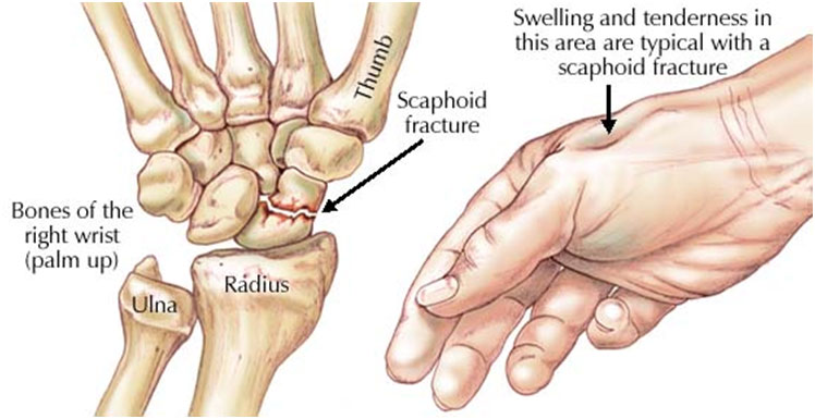 durere articulară scafoidă unguent pentru degete cu artrită