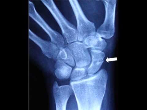 artroza scafoidă a scafoidului artroza semnelor de tratament ale articulației genunchiului