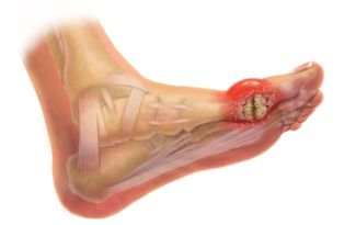 articulația umflată și dureroasă pe picior