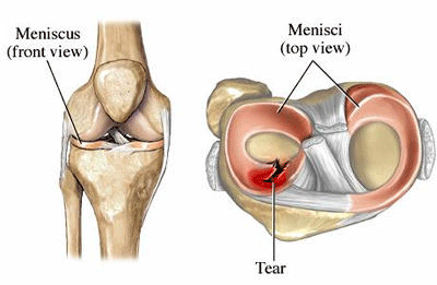 leziune corn posterior menisc intern inflamație acută a articulațiilor piciorului