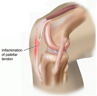 Ruptura de tendon