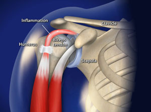 dureri articulare la biceps