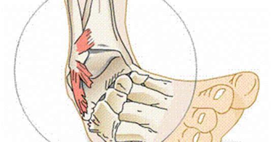 Ce trebuie să știți despre entorsa de genunchi